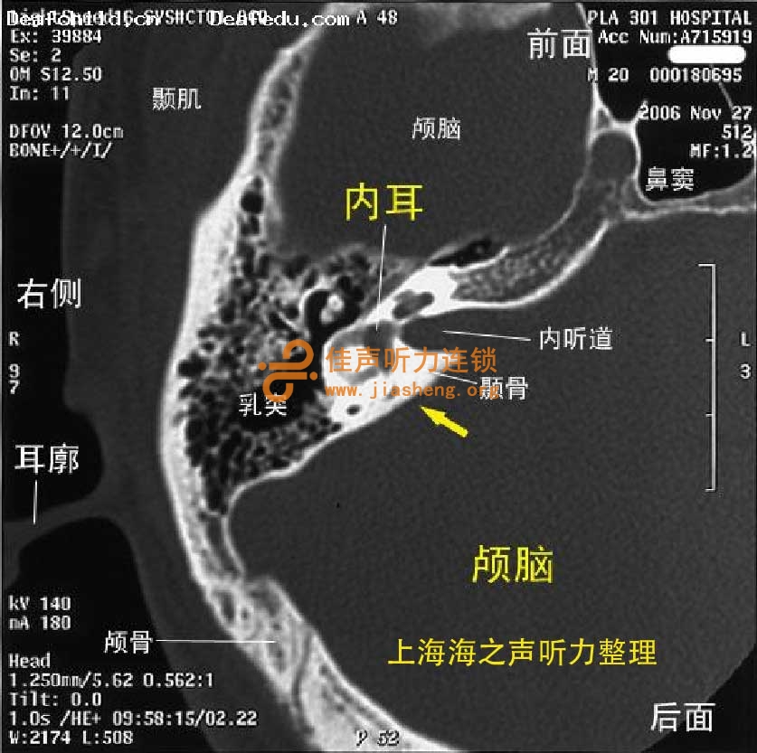 大前庭导水管综合症/前庭导水管扩大（LVAS）